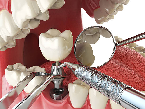 Best Emergency Root Canal Treatment in North Haledon, NJ